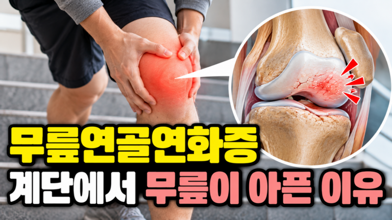무릎연골연화증 계단에서 무릎이 아픈 이유