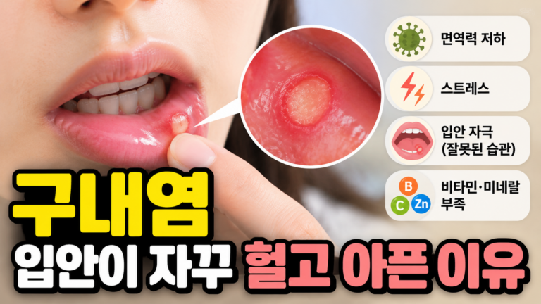 구내염 입안이 자꾸 헐고 아픈 이유 8 구내염 입안이 자꾸 헐고 아픈 이유