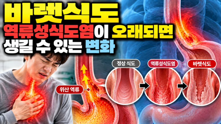 바렛식도 역류성식도염이 오래되면 생길 수 있는 변화