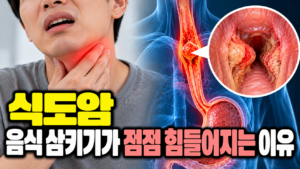 식도암 음식 삼키기가 점점 힘들어지는 이유