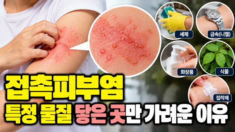 접촉피부염 특정 물질 닿은 곳만 가려운 이유 1 접촉피부염 특정 물질 닿은 곳만 가려운 이유