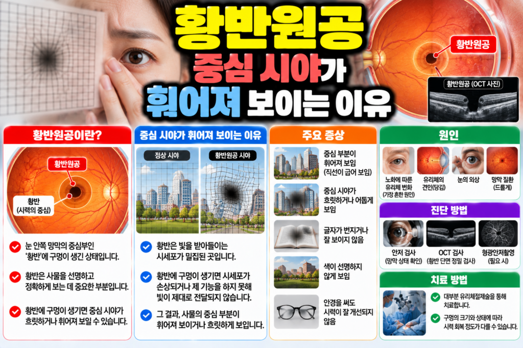 황반원공 중심 시야가 휘어져 보이는 이유
